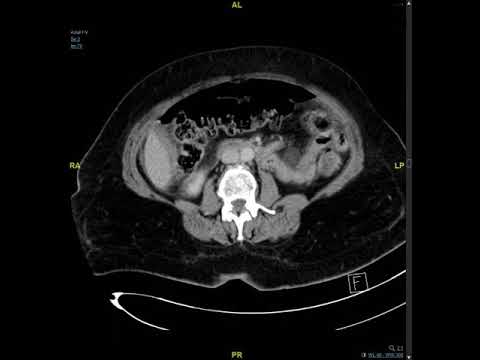 Abdominal CT scan showing perforated duodenum with pneumoperitoneum and free fluid
