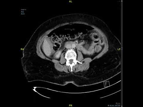 Ct-Scan Onthult Vergrote Lymfeklier In De Buik: Wat Je Moet Weten