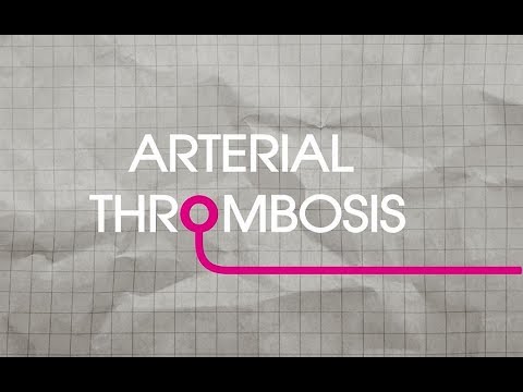 Arterial Thrombosis Explained